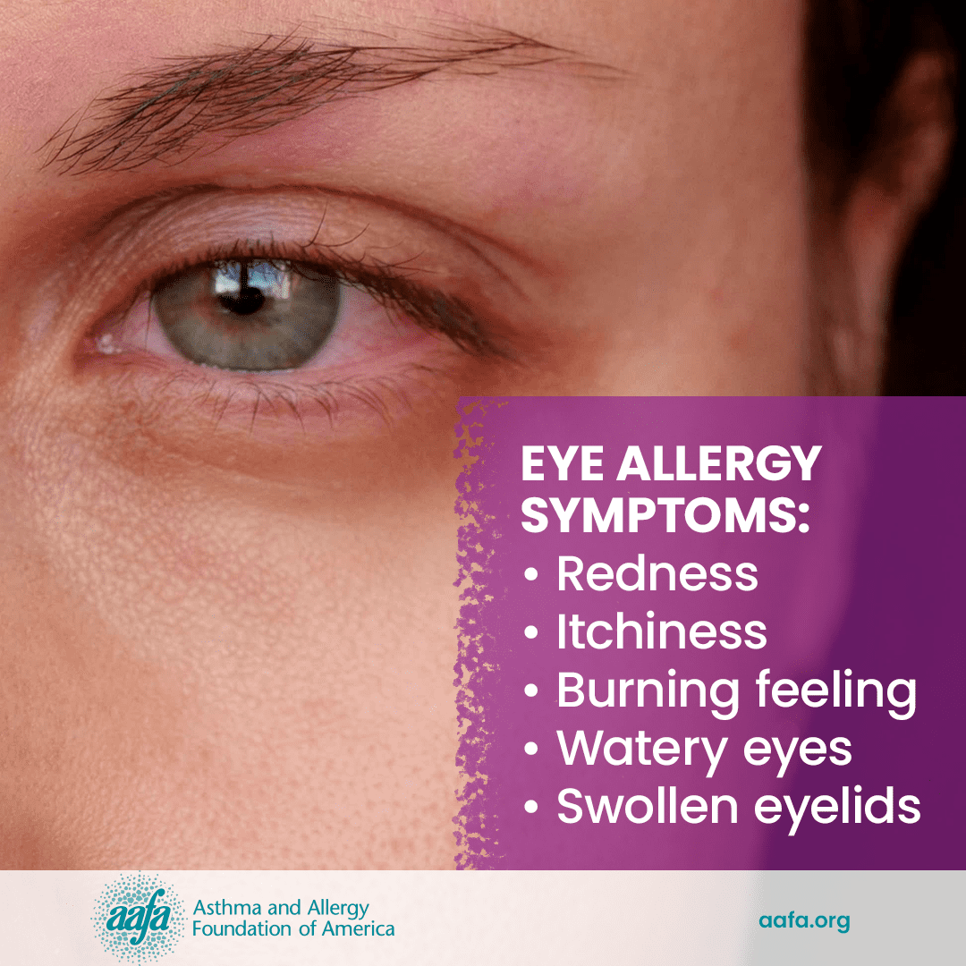 Eye Allergy Symptoms Allergy Education FB 