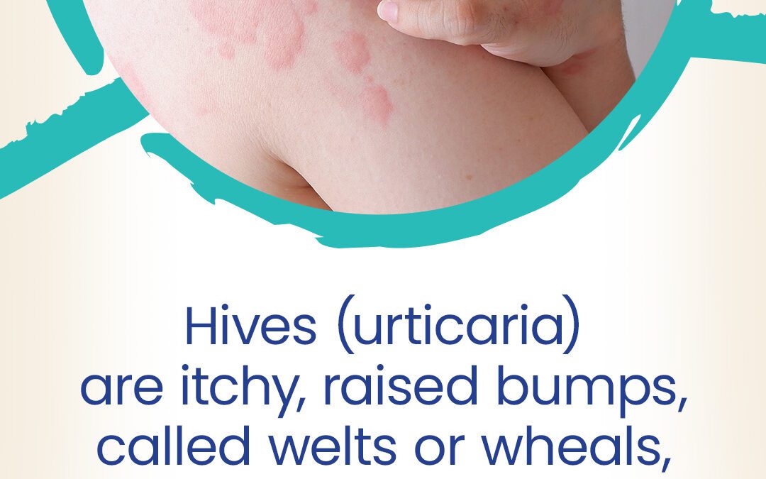 Urticaria Day: Raising Awareness of Symptoms and Treatment