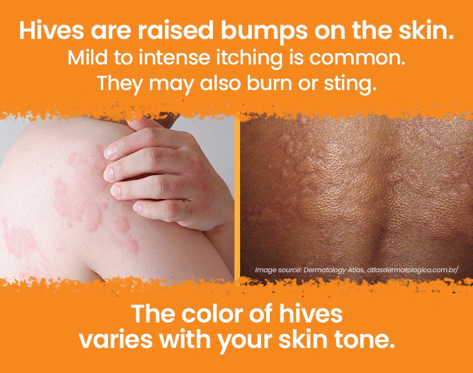 Hives are raised bumps on the skin. Mild to intense itching is common. They may also burn or sting. The color of hives varies with your skin tone.