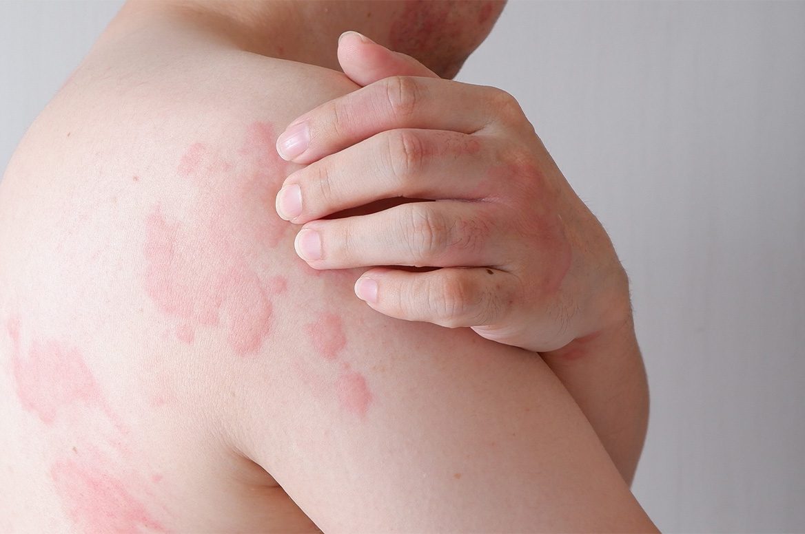 Group of various fruits--what is oral allergy syndrome banner